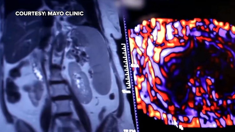 Healthy SA: Battling liver cancer, a disease which often has no symptoms early on — KENS 5 (San Antonio), Saratoga Health news