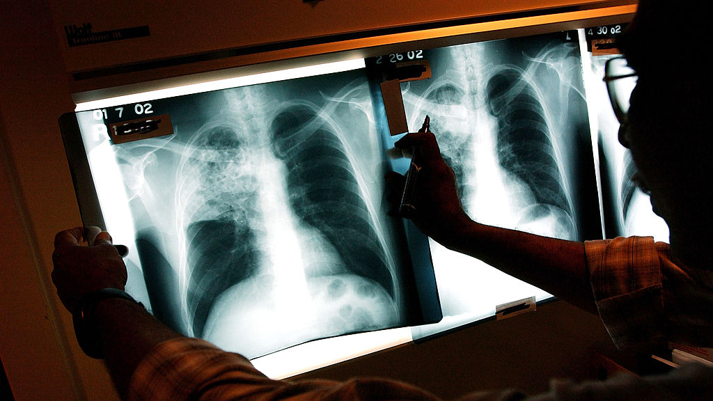2 active tuberculosis cases traced to San Francisco strip club — KTVU FOX 2 Bay Area, Saratoga Health news